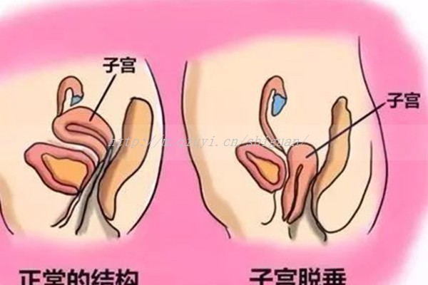 试管移植后能不能爬楼梯？强度过大会影响胚胎着床